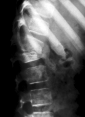 Based on this 11 year old boy's x ray, what do you suspect is the cause?