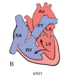 Left to right shunt in interventricular septum

increased pulmonary blood volume AND pressure

muscular (more likely to close) or membranous 90% types 

Most close spontaneously, 30% are isolated

Cause pulmonary hypertension, shunt revers...
