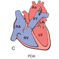 Ductus arteriosus normally closes 1-2d after birth, remains open in PDA

90% isolated, 10% with VSD

Dilated pulmonary arteries, RV, RA (from pulmonary hypertension)

Gives harsh machine like murmur, may be asymptomatic

Can be life saving...