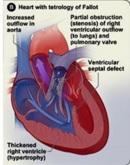 Most common cause of cyanotic congenital heart disease

Subpulmonic stenosis, VSD, overriding aorta (placed directly above VSD, gets blood from both ventricles), RV hypertrophy (boot shaped heart)

Severity dependent on RV outflow obstruction,...