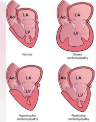 dilated: enlarged four chamber dilation, hypertrophy, flabby, mural thrombus (systole problem, can't contract)

Hypertrophic: hypertrophy (usually asymmetric), no dilation, diastole problem can't contract

Restrictive: normal heart size, but s...