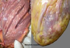 Most common tumor in heart

common ones: lung adenocarcinoma, breast cancer, leukemia / lymphoma, melanoma

Melanoma identified by brown pigment , lymphomas identified via markers