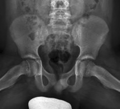 In the setting of the condition pictured here in a boy with right hip pain. The right leg will be in obligate ______________