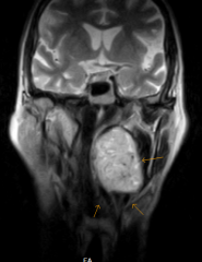 CT or MRI with contrast (hypervascular mass, usually splaying internal and external carotid)
MRI appearance described as "salt and pepper"
Halo between carotid and tumor suggests a good plane of separation. 

- remember, if the tumor is locate...
