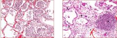 What two inflammatory responses are occurring here in the lung tissue