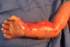 Immediately after birth following a long labor, the baby's arm looks like this. What is the next step?
