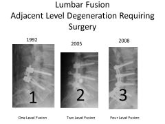 1- Obtain MRI; 2-Refer to a vascular surgeon for tx of PVD; 3-lumb decomp; 4-lumb decomp & instrum fusin 
5-lumb decomp & uninstrumented fusn::: neurogenic claudication due to grade I degen spondylolisthesis @ L4/5. successful arthrodesis occurre...