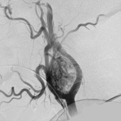 The lyre sign refers to the splaying of the internal and external carotid by a carotid body tumour. Classically described on angiography it is also visible on CT angiography.