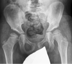 The 5 year old child pictured was treated with a Pavlik harness for right hip dislocation. Given his x ray findings, of acetabular index of 31 on the right, and 15 on the left, what is the appropriate treatment?