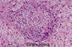 -granuloma formation is a complex process that occurs over several days to weeks in response to an antigen that can't be eradicated by the usual immune mechanisms

-activated Th1 CD4+ cells secrete interferon-gamma, which activates macrophages
...
