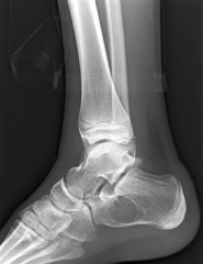 10 year old child with heel pain and a limp. No trauma. Based on the x-rays, what lab abnormalities do you expect?