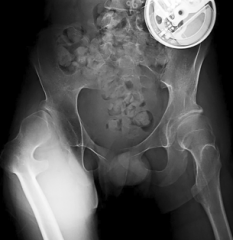 17 year old GMFCS V with x-rays shown. How do you treat?