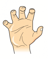 Klumpke Palsy
- Intrinsic hand muscle deficits (lumbricals, interossei, thenar, and hypothenar) → Total claw hand 
- Lumbricals normally flex MCP joints and extend DIP and PIP joints