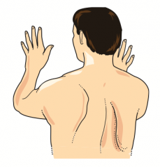 Winged Scapula:
- Deficit of Serratus Anterior muscle → inability to anchor scapula to thoracic cage → cannot abduct arm above horizontal position