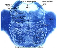 CSF-corticospinal fibers 
MCP-middle cerebellar tract 
MENu-mesencephalic nucleus 
ML-medial lemniscus 
PNF-pontine nucleus and fibers 
RST-rubrospinal tract 
SCP-superior cerebellar peduncle  
SMV-superior medullary velum