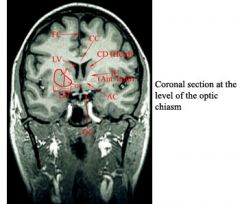 AC-anterior commissure 
CC- corpus collosum 
CD-caudate nucleus 
FC-falx cerebri 
GP-globus pallidus 
IC-internal capsule 
LN-lentiform nucleus 
LV-lateral ventricle 
OC-optic chiasm 
Pu-putamen
