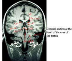 4V-fourth ventricle 
C-cerebellum 
CA-cerebral aqueduct 
Ch-choroid plexus 
CQ-corpora quadremina 
Fx-fornix 
H-hippocampus 
LV-lateral ventricle 
MCP-middle cerebellar peduncle 
P-pulvinar