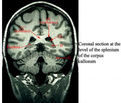 C-cerebellum 
CC-corpus collosum 
Ch-choroid plexus 
H-hippocampus 
LV-lateral ventricle
