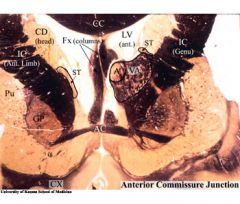 A-anterior nucleus 
AC-anterior commissure 
CC- corpus collosum 
CD-caudate nucleus 
CX-cortex 
Fx-fornix 
GP-globus pallidus 
IC-internal capsule 
LV-lateral ventricle 
Pu-putamen 
ST-stria terminalis 
VA-ventral anterior nucleus