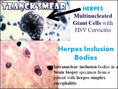 If you suspect a patient may have herpes, what sort of lab test would you use to diagnose? What would you say if the test was negative?