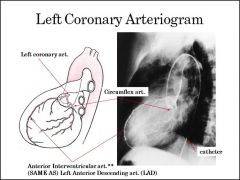 The left coronary artery supplies the majority of the left side of the heart. 

Blockage may lead to left ventricular failure.