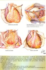 1. PERICARDITIS- inflammation of the pericardium
2. PERICARDIAL EFFUSION– the potential space becomes a real space with build up of fluid
3. CARDIAC TAMPONADE– pericardial effusion -> heart compressed because fibrous pericardium cannot stretch!
4. CARD