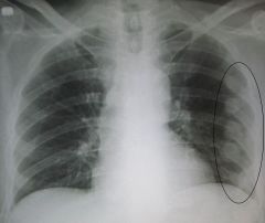 When looking @ x-rays, which ribs of thorax are usually the easiest to fracture? Most difficult?