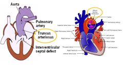 Persistent TRUNCUS Arteriosus= MALFORMATION RELATED TO NEURAL CREST CELL MIGRATION
* Neural crest cells do not migrate to form the spiral septum
* Oxygenated and deoxygenated blood mix and systemically recirculate
* Not lethal but decreased physical ac