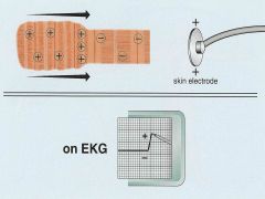 On an EKG, up is positive, and down is negative. 

1. What do you call any initial negative deflection on an EKG? 2. 2. What are all positive deflections on an EKG called?
3. In the EKG, what do we call any negative (-) deflection that follows an R wav