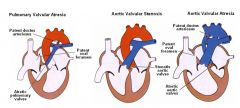 If the great vessel valves do not form properly, (atresia) or become greatly narrowed (stenosis) it is often very fatal. How do the valves of the heart develop?