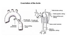 What might coarctation of the aorta (a birth defect) present itself in a patient? What might you see if someone had it?