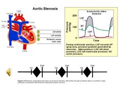 *As aorta ages, it gradually becomes more calcified... and may lead to aortic stenosis.

*This sounds like the HARSHEST sounding murmur you may hear. (like waves crashing almost)

*Aortic stenosis (narrowing of the aortic valve): Left ventricular hype