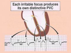 What type of pathology might you see in a person that has:

1. a mid-systolic click with a late systolic (decrescendo) murmur

1. A wide QRS signal on an EKG= aka PREMATURE VENTRICULAR Contraction  (PVC)

What might happening inside the heart that c