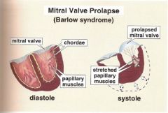 MITRAL VALVE PROLAPSE causes PVCs (including runs of VT and multifocal PVC), yet it is actually considered a benign condition. The valve is floppy and "billows" in to left atrium when 

During ventricular systole, billowing valves pull on the chorade th