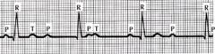 What is the order of normal conduction in the pathway of the heart? What happens when this gets fcuked up? What is it called?