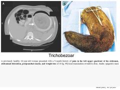 Trichobezoar
Stomach can distend and accomidate lots of room