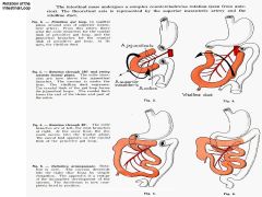 270 counter clockwise rotation 

The Gut Tube: Formation of Intestines
•	The endodermal gut tube grows very quickly - faster than the peritoneal cavity. 
•	It bulges ventrally -and is forced into the body stalk for five weeks (physiological umbilical 