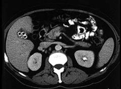 GALLSTONES Main Point:  We have not looked a lot of US.  But the key to remember when looking at US is that the anatomy is exactly the same once you figure out your orientation.   

Here is another picture of it on an CT.