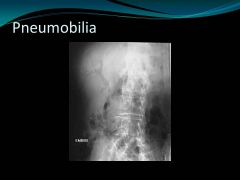 Pneumobilia

Main Point: Gas can get into the bile ducts and the potal veins.  By knowing the anatomy, you can identify those structures when this finding is present.