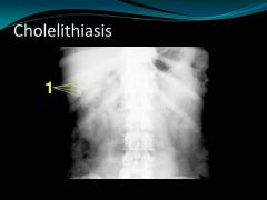 Cholelithiasis

Main Point: remember the 5 radiographic densities.  If it looks like bone but is not a bone, it is a calcified structure.  Even though we can’t see the gall bladder on plain film, when there are stones  located In RUQ where we would expe