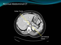 How can you tell the difference between celiac vs SMA on CT cross section?
