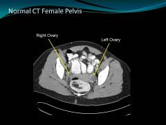 find uterus, and ovary should be nearby