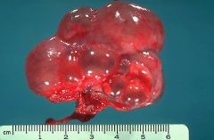 Multicystic Dysplastic Kidney!! 

eww