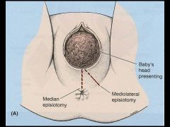 Episiotomy:

Benefits
+Speeds up the birth.
+Prevents tearing.
+Protects against incontinence.
+Heals easier than tears.	

Dangers
-Infection.
-Increased pain.
-Longer healing times.
-Increased discomfort when intercourse is resumed.