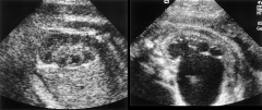 On the left is what a normal prenatal kidney looks like on ultrasound... and the other image obviously has something very wrong with that kidney.   Why is this happening? What could cause this?!