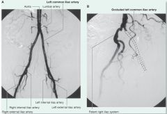 Digital subtraction aortoiliac angiogram. A. Normal circulation pattern. B. Occluded left common iliac artery