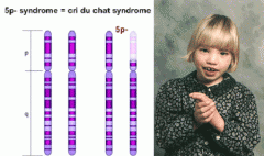 Cri du chat syndrome

weak cat-like cry when they are born; microcephaly; severe mental retardation, heart anomalies