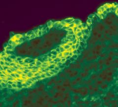 Immunofluorescence shows intrecellular IgG deposition in a patient with bullous skin lesions, characterstic of what disease?