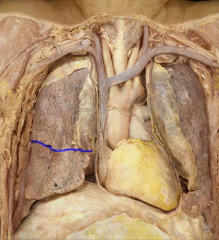 Horizontal fissure of the right lung