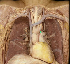 Ligamentum arteriosum